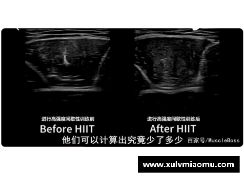 体育巨星接受胆囊切除手术：健康挑战与职业体能的平衡